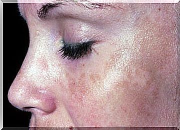 Melasma