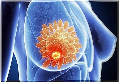 Breast Cysts - Which Diet Can Help?