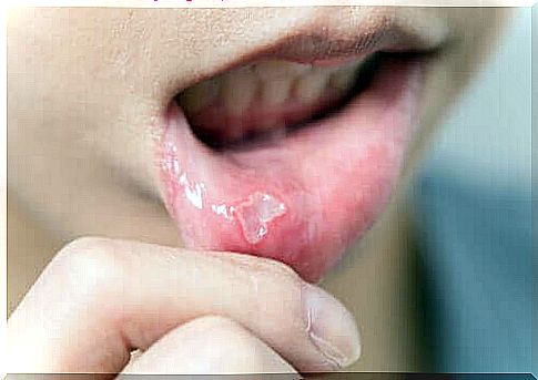 Cold sores in children and their treatment