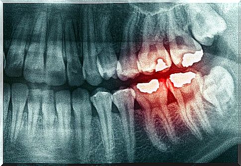 Grinding teeth - reasons and possible consequences