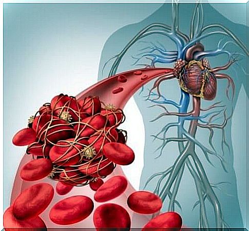 Thrombosis