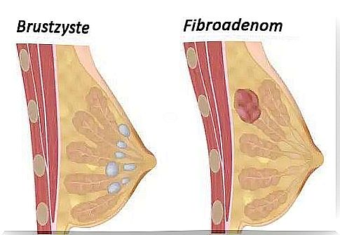 How can you avoid breast cysts?