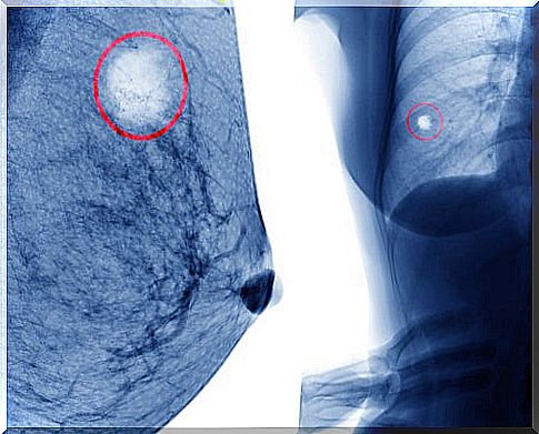 Breast cyst radiography