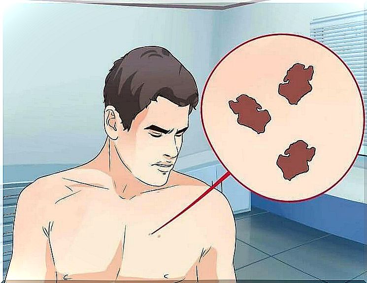 How do you recognize malignant moles?