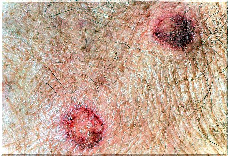 Moles can form skin cancer