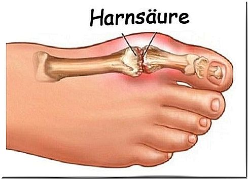 Too much uric acid is harmful to the body