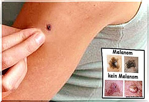 Melanoma: prevention and early detection