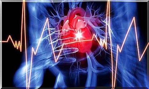 What is a pericardial effusion 