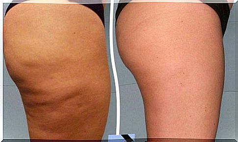 Simple, homemade cellulite treatments