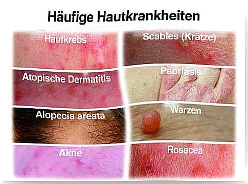 The most common skin diseases