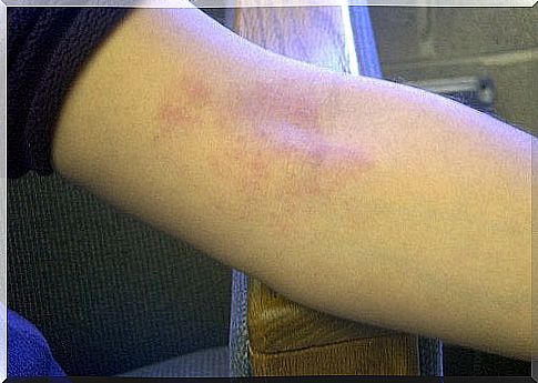 Skin diseases on the arms