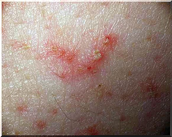 Skin disorders