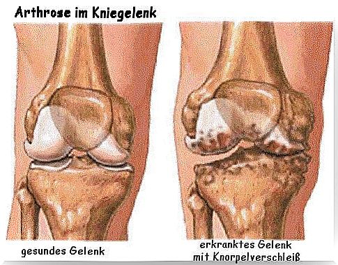 Osteoarthritis Symptoms and Prevention