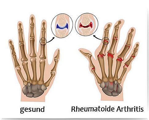 arthritis